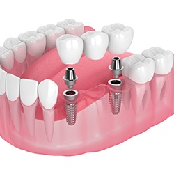 Animated smile with two dental implants supporting a dental bridge