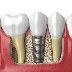 Dental implant post in the lower jaw after bone grafting