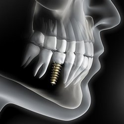 X-ray of a patient with a single dental implant