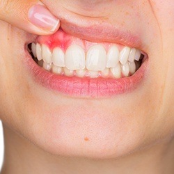 Closeup of smile with damaged soft tissue before gum disease treatment
