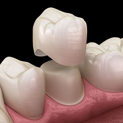 Illustration of dental crown being placed on tooth