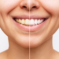 Closeup of patient's teeth before and after teeth whitening