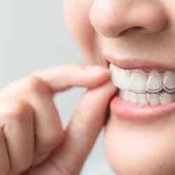 Closeup of patient putting on clear aligner